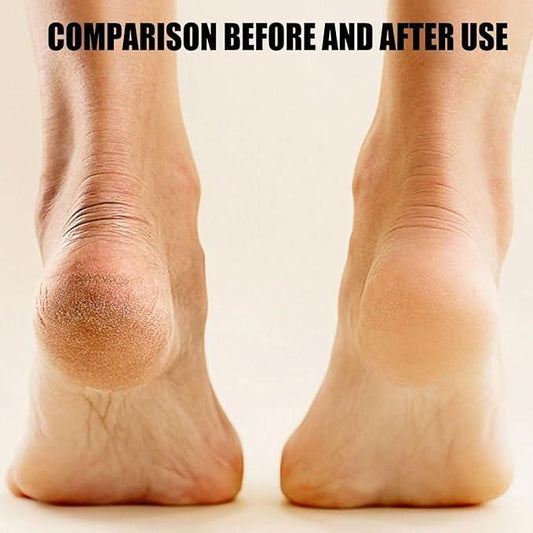 Electronic Pedicure Tool – Smooth, Soft Feet Made Easy